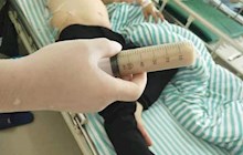 【“肺腑”之言】咳嗽、發(fā)熱又胸悶，小心是膿胸！