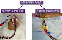 透析患者中心靜脈留置導(dǎo)管的居家護(hù)理