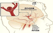突發(fā)頭暈嘔吐，竟是因?yàn)槟X子里的這枚“不定時(shí)炸彈”……